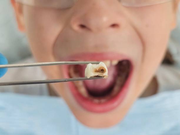 Best Emergency Tooth Extraction in Lake Clarke Shores, FL