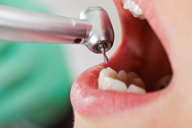 Best Emergency Dental Care for Broken or Chipped Teeth in Lake Clarke Shores, FL